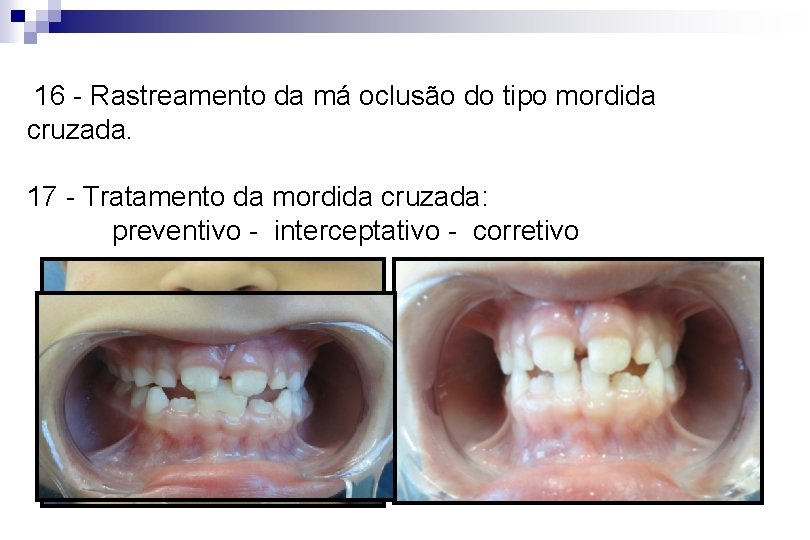  16 - Rastreamento da má oclusão do tipo mordida cruzada. 17 - Tratamento