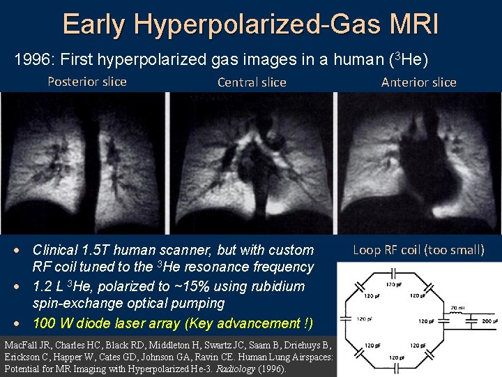 Early Hyperpolarized-Gas MRI 1996: First hyperpolarized gas images in a human (3 He) Posterior