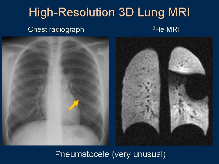 High-Resolution 3 D Lung MRI Chest radiograph 3 He MRI Pneumatocele (very unusual) 