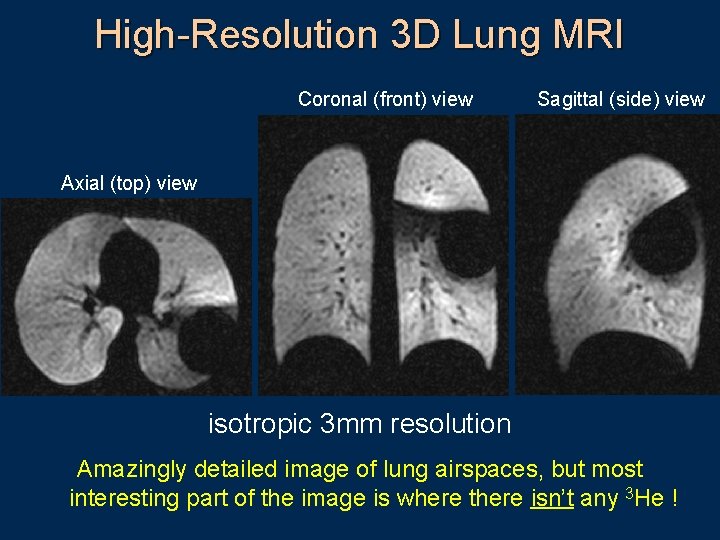 High-Resolution 3 D Lung MRI Coronal (front) view Sagittal (side) view Axial (top) view