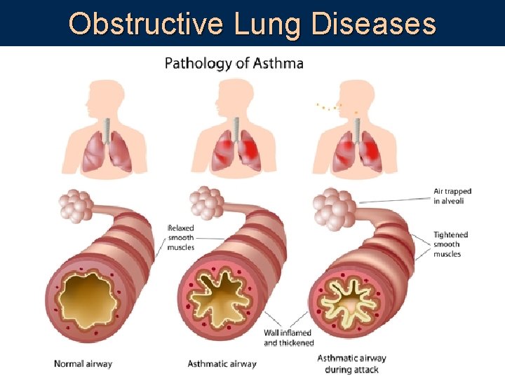 Obstructive Lung Diseases 