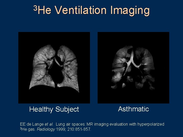 3 He Ventilation Imaging Healthy Subject Asthmatic EE de Lange et al. Lung air