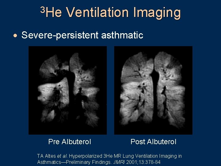 3 He Ventilation Imaging · Severe-persistent asthmatic Pre Albuterol Post Albuterol TA Altes et