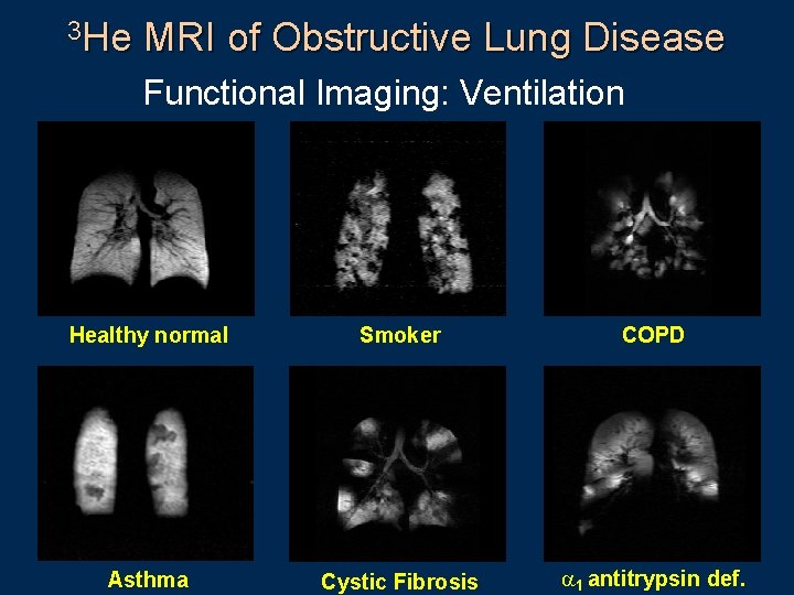 3 He MRI of Obstructive Lung Disease Functional Imaging: Ventilation 129 Xe in lung