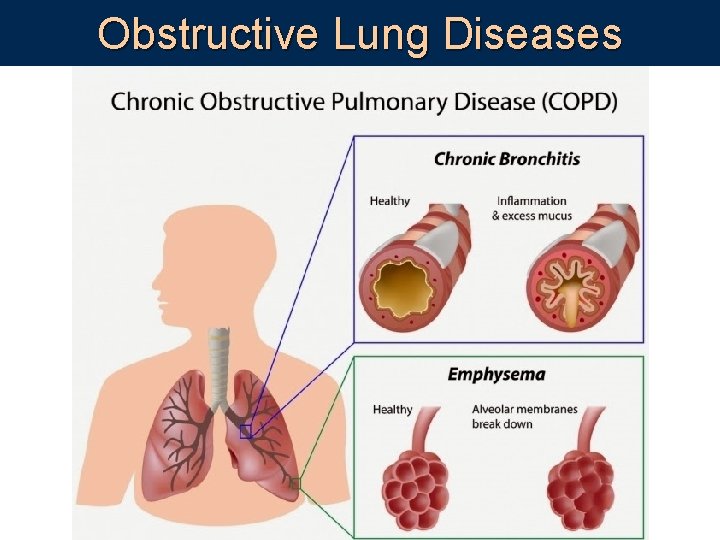Obstructive Lung Diseases 
