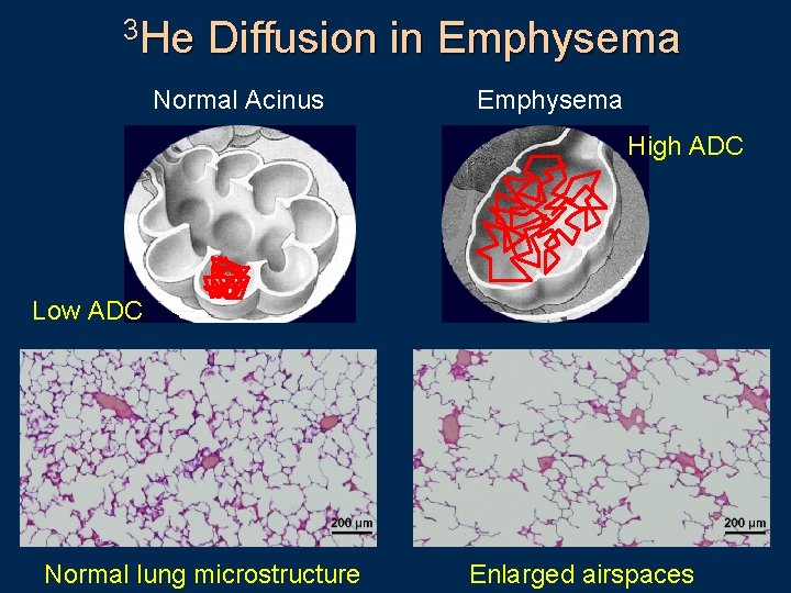 3 He Diffusion in Emphysema Normal Acinus Emphysema High ADC Low ADC Normal lung