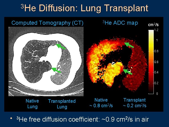 3 He Diffusion: Lung Transplant Computed Tomography (CT) Native Lung Transplanted Lung 3 He