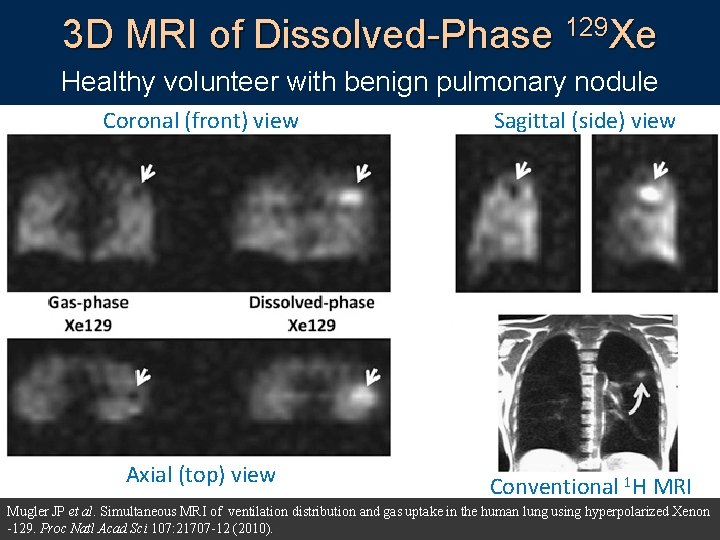 3 D MRI of Dissolved-Phase 129 Xe Healthy volunteer with benign pulmonary nodule Coronal