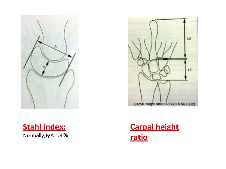Stahl index: Normally; B/A= 50% Carpal height ratio 