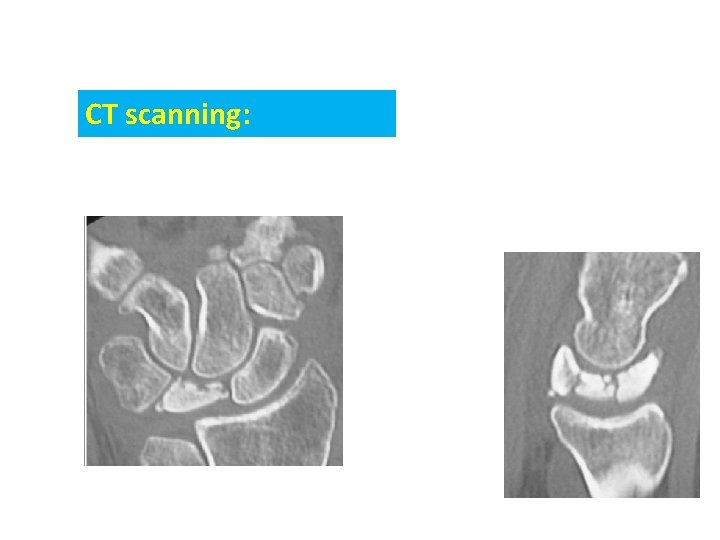 CT scanning: 