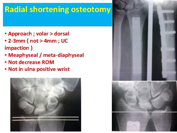 Radial shortening osteotomy • Approach ; volar > dorsal • 2 -3 mm (