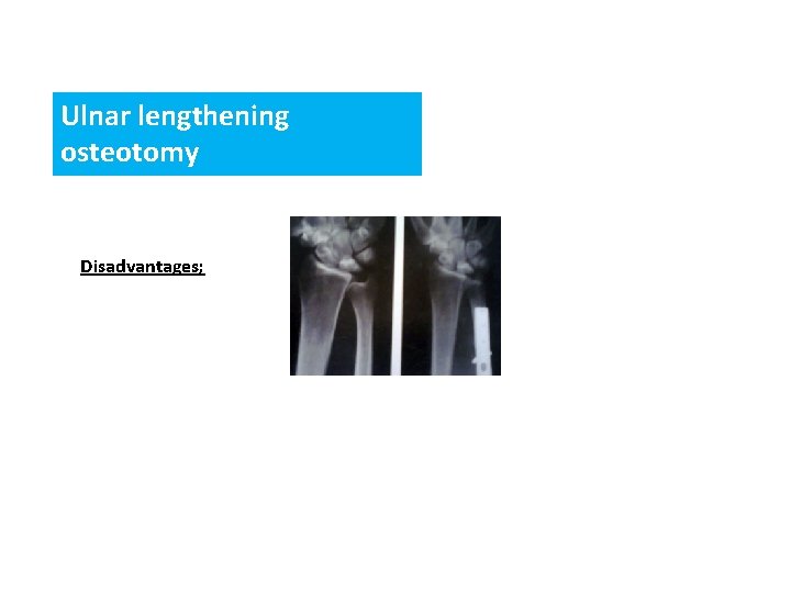 Ulnar lengthening osteotomy Disadvantages; 