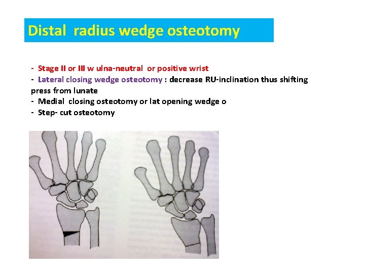 Distal radius wedge osteotomy - Stage II or III w ulna-neutral or positive wrist