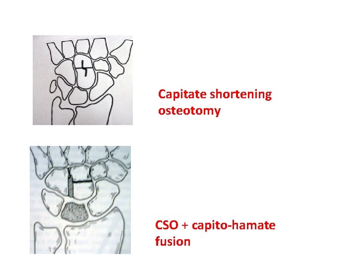 Capitate shortening osteotomy CSO + capito-hamate fusion  Capitate shortening osteotomy CSO + capito-hamate fusion