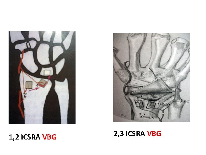1, 2 ICSRA VBG 2, 3 ICSRA VBG  1, 2 ICSRA VBG 2, 3 ICSRA VBG