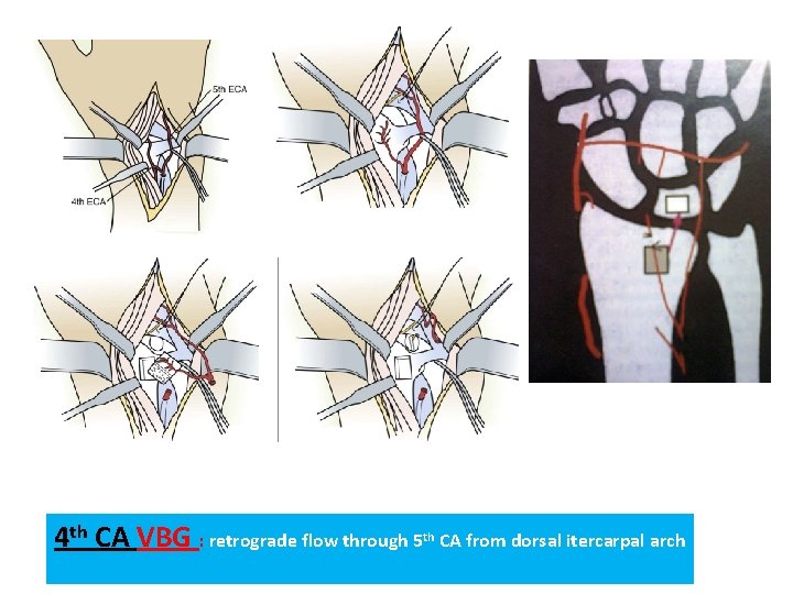 4 th CA VBG : retrograde flow through 5 th CA from dorsal itercarpal