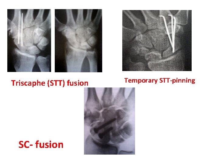 Triscaphe (STT) fusion SC- fusion Temporary STT-pinning 