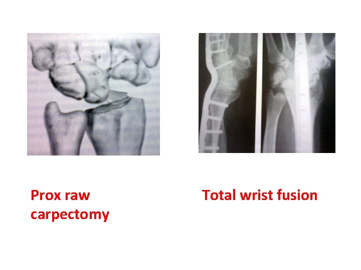 Prox raw carpectomy Total wrist fusion 