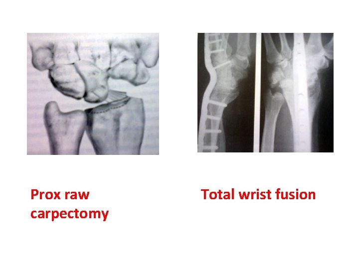 Prox raw carpectomy Total wrist fusion  Prox raw carpectomy Total wrist fusion