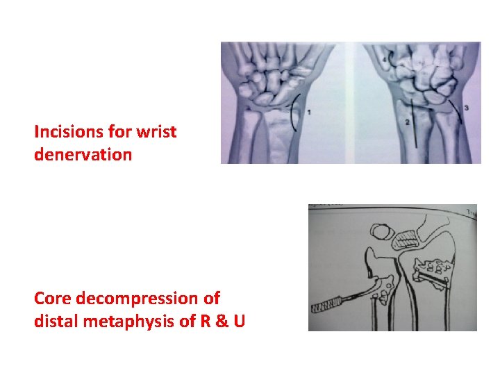 Incisions for wrist denervation Core decompression of distal metaphysis of R & U 