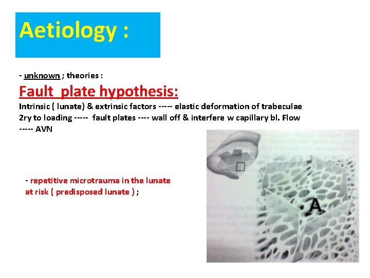 Aetiology : - unknown ; theories : Fault plate hypothesis: Intrinsic ( lunate) & Aetiology : - unknown ; theories : Fault plate hypothesis: Intrinsic ( lunate) &