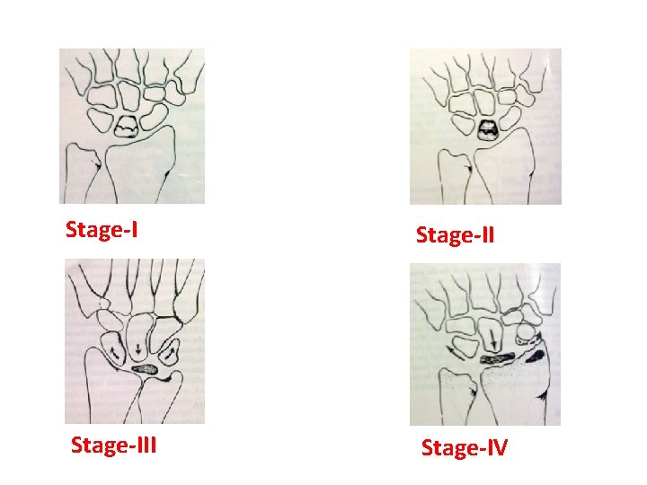 Stage-III Stage-IV 