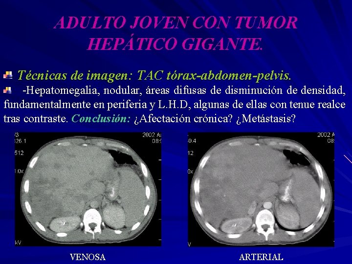 ADULTO JOVEN CON TUMOR HEPÁTICO GIGANTE. Técnicas de imagen: TAC tórax-abdomen-pelvis. -Hepatomegalia, nodular, áreas