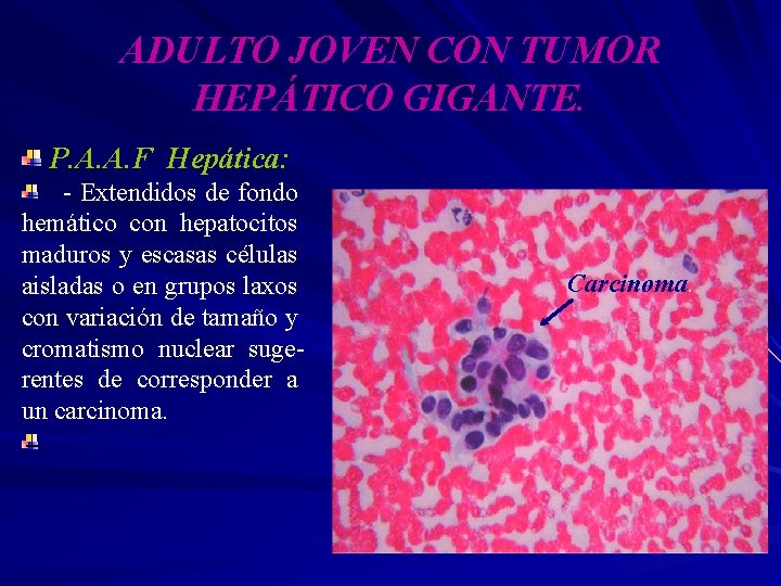 ADULTO JOVEN CON TUMOR HEPÁTICO GIGANTE. P. A. A. F Hepática: - Extendidos de