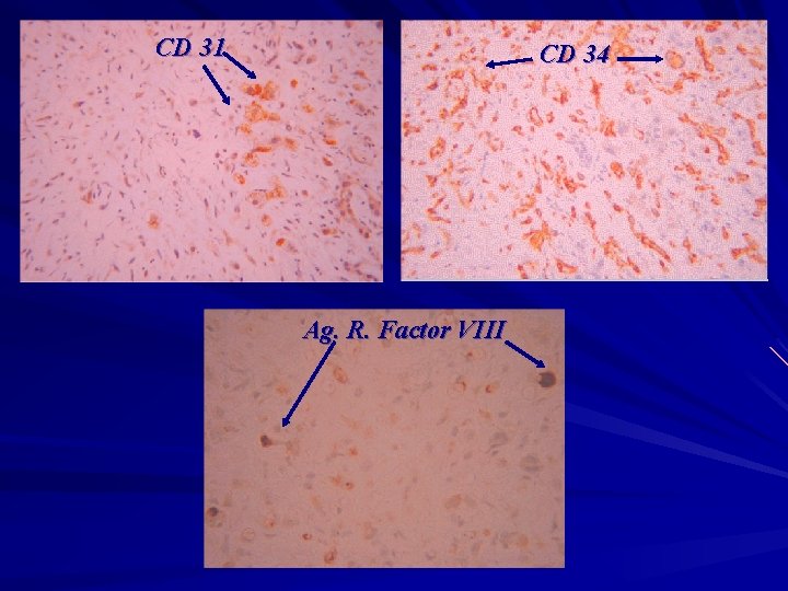 CD 31 CD 34 Ag. R. Factor VIII 