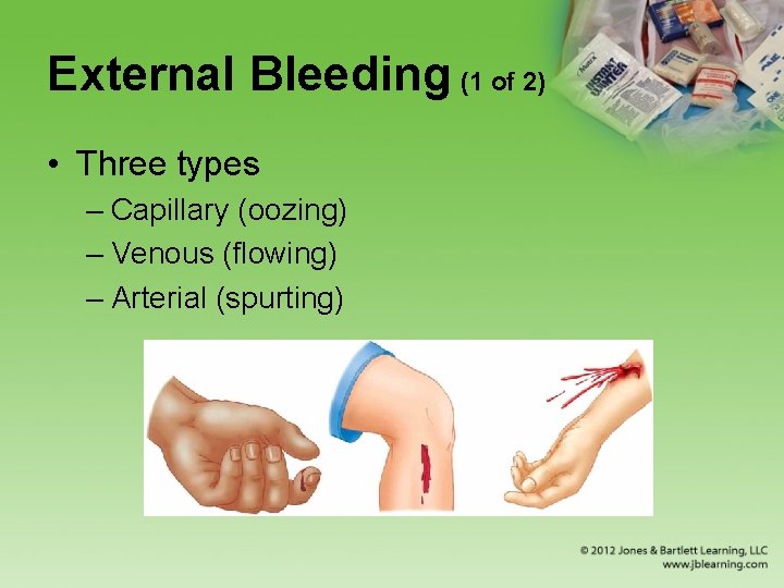 External Bleeding (1 of 2) • Three types – Capillary (oozing) – Venous (flowing)