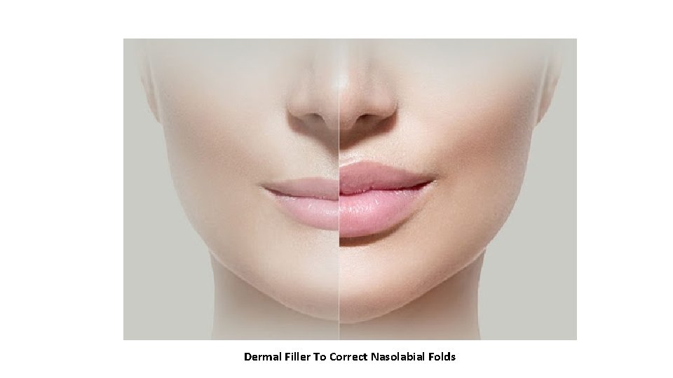 Dermal Filler To Correct Nasolabial Folds 