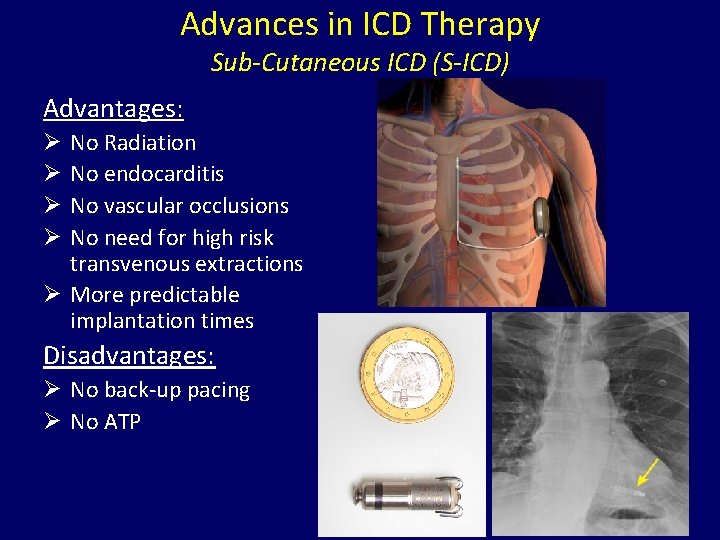 Advances in ICD Therapy Sub-Cutaneous ICD (S-ICD) Advantages: No Radiation No endocarditis No vascular