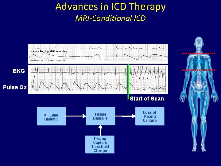Advances in ICD Therapy MRI-Conditional ICD EKG Pulse Ox Start of Scan RF Lead