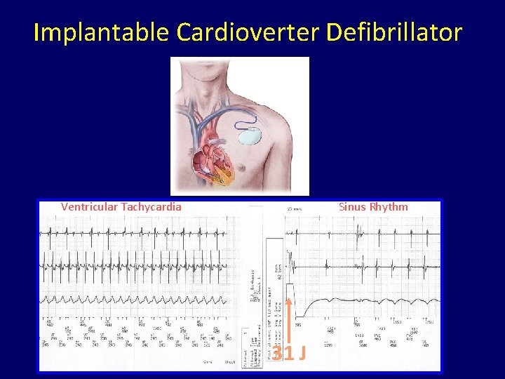 Implantable Cardioverter Defibrillator Ventricular Tachycardia Sinus Rhythm 31 J 