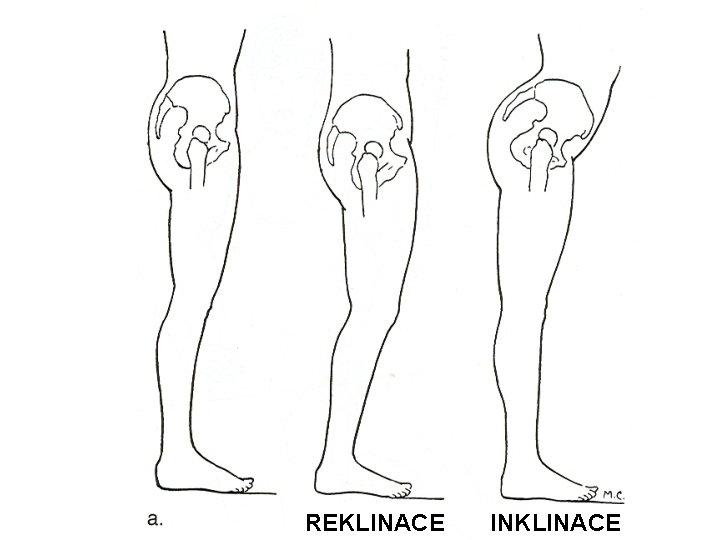 REKLINACE INKLINACE 