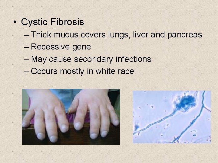  • Cystic Fibrosis – Thick mucus covers lungs, liver and pancreas – Recessive