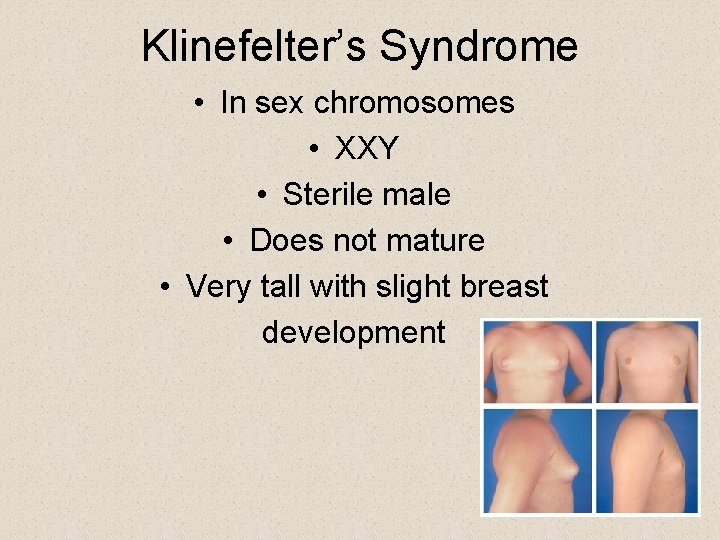 Klinefelter’s Syndrome • In sex chromosomes • XXY • Sterile male • Does not