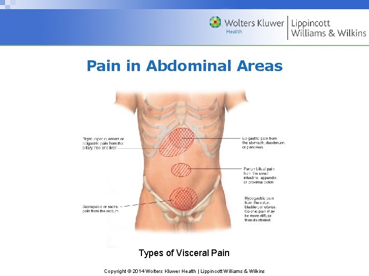 Pain in Abdominal Areas Types of Visceral Pain Copyright © 2014 Wolters Kluwer Health