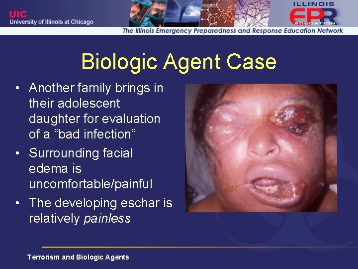 Biologic Agent Case • Another family brings in their adolescent daughter for evaluation of