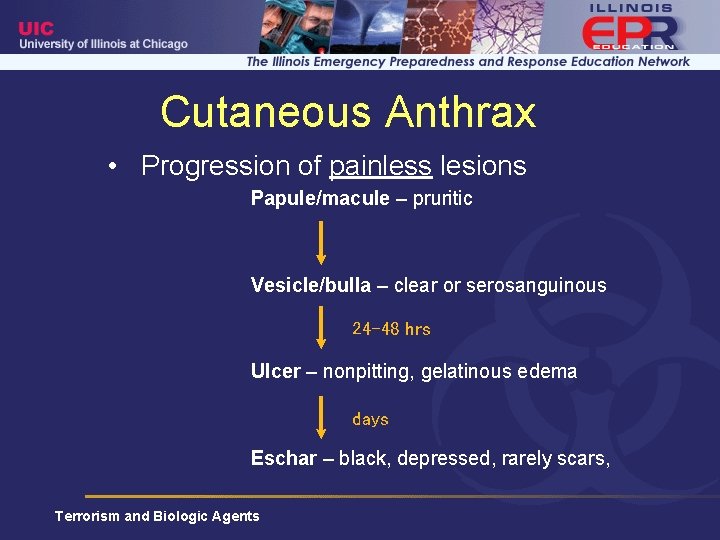 Cutaneous Anthrax • Progression of painless lesions Papule/macule – pruritic Vesicle/bulla – clear or