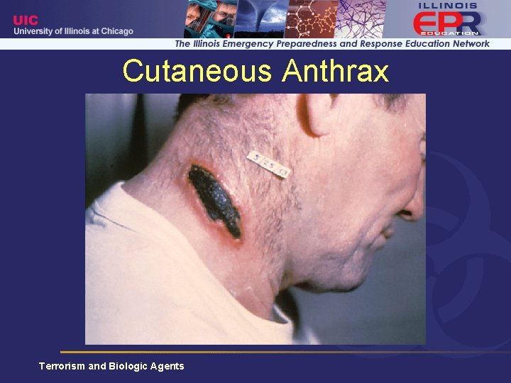 Cutaneous Anthrax Terrorism and Biologic Agents 