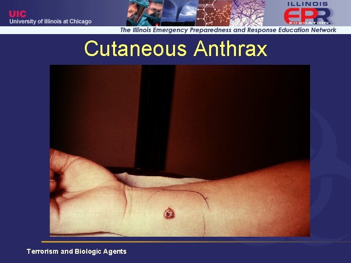 Cutaneous Anthrax Terrorism and Biologic Agents 
