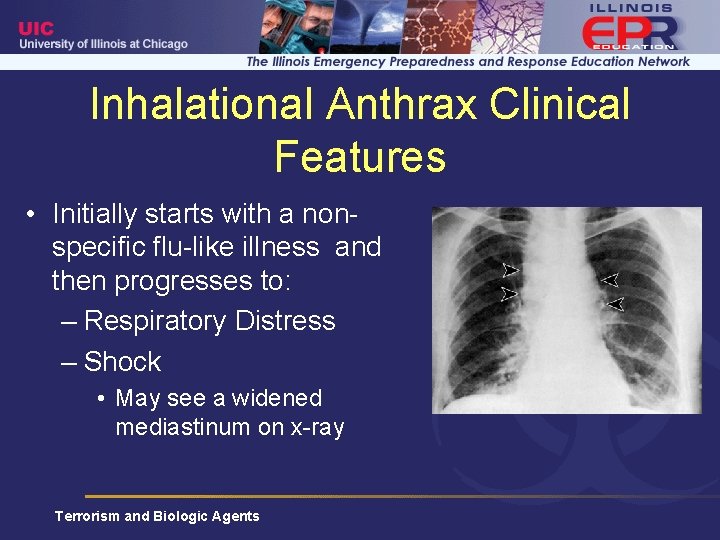 Inhalational Anthrax Clinical Features • Initially starts with a nonspecific flu-like illness and then