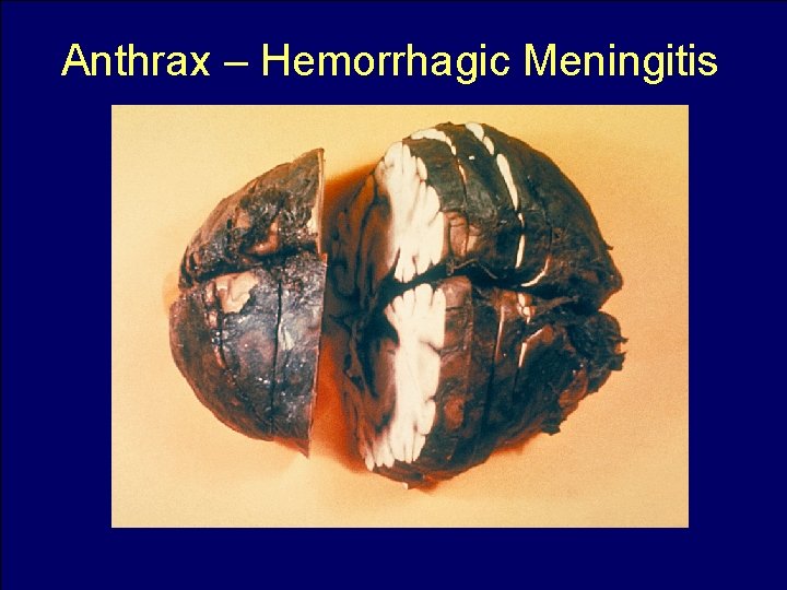 Anthrax – Hemorrhagic Meningitis 