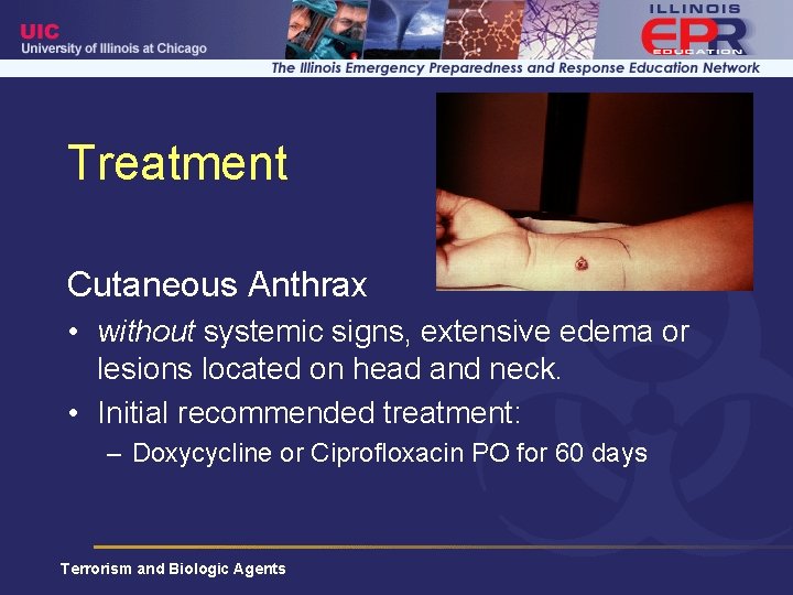 Treatment Cutaneous Anthrax • without systemic signs, extensive edema or lesions located on head