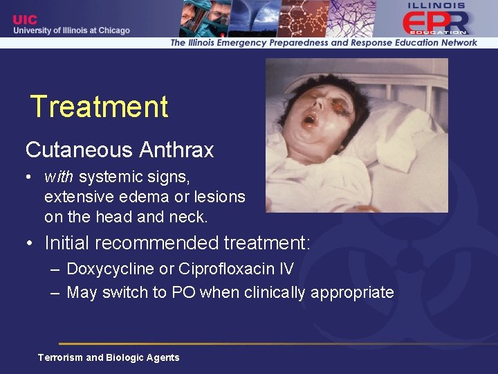 Treatment Cutaneous Anthrax • with systemic signs, extensive edema or lesions on the head