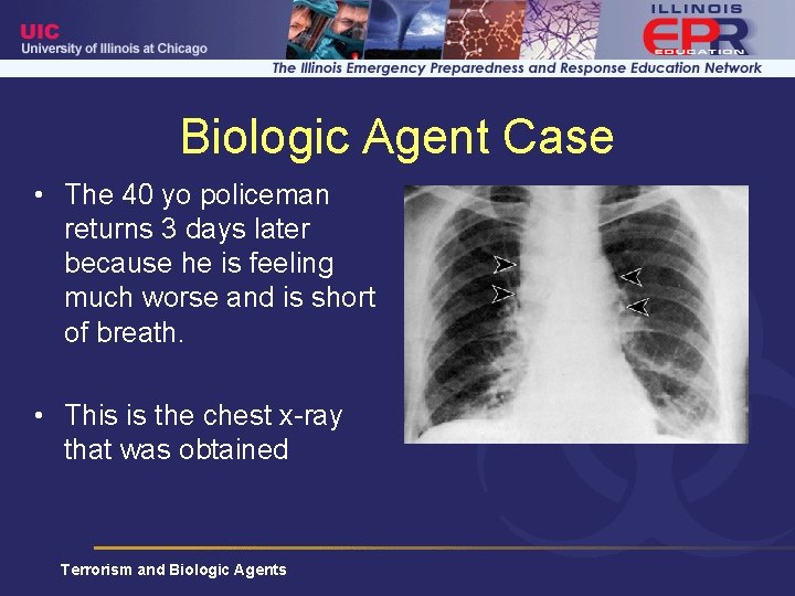 Biologic Agent Case • The 40 yo policeman returns 3 days later because he