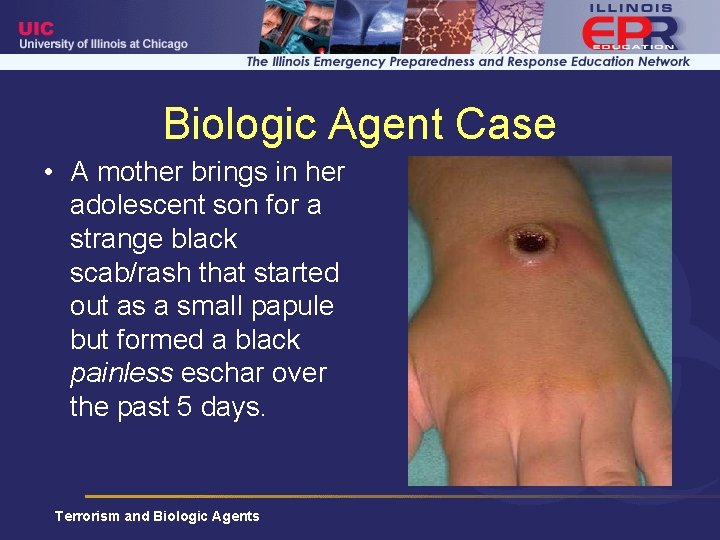 Biologic Agent Case • A mother brings in her adolescent son for a strange