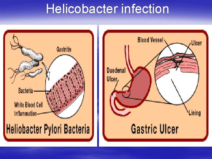 Helicobacter infection 