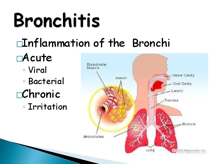 Bronchitis �Inflammation �Acute ◦ Viral ◦ Bacterial �Chronic ◦ Irritation of the Bronchi 